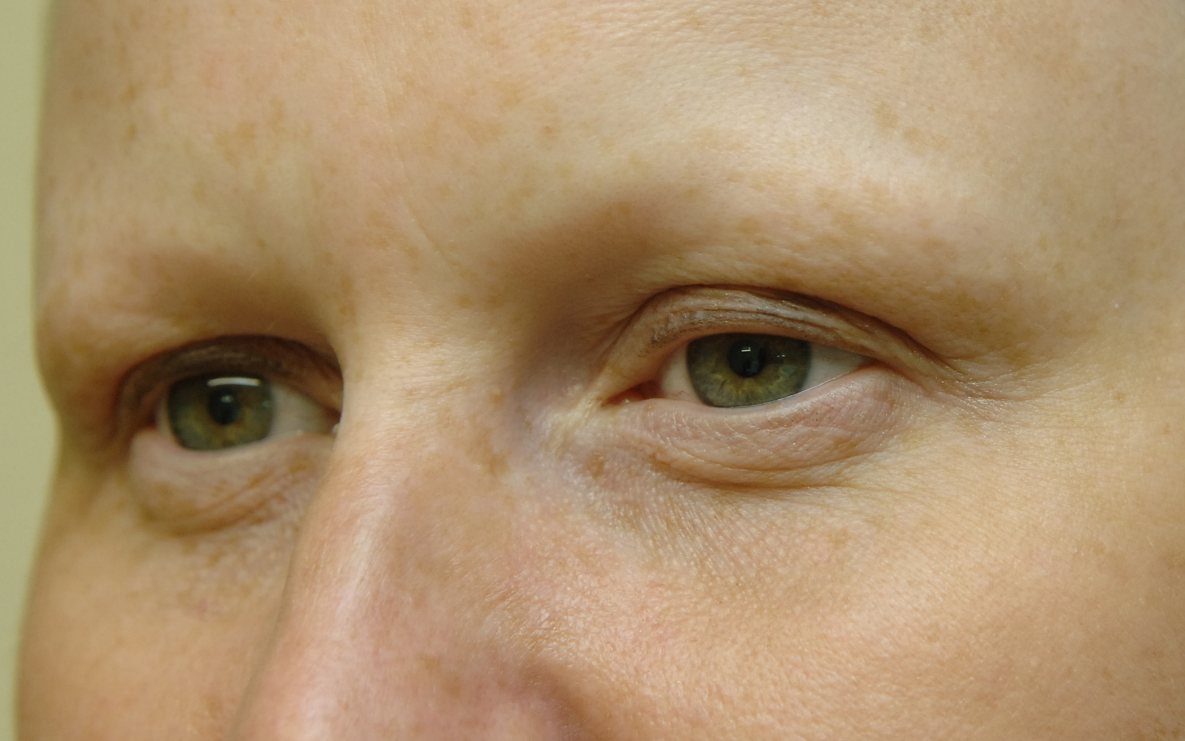 Related Keywords amp; Suggestions for eyebrow alopecia